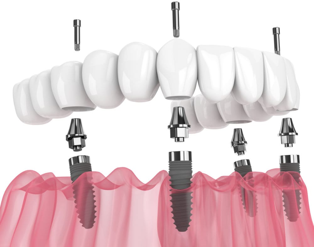 All On Four, Implant-Supported Dentures