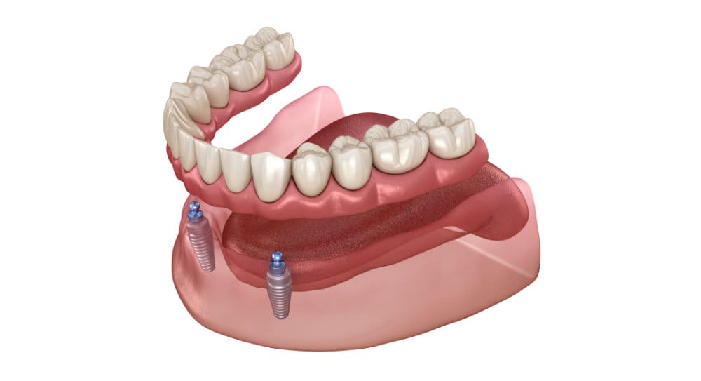 Overdenture to be seated on 2 implants - ball attachments.