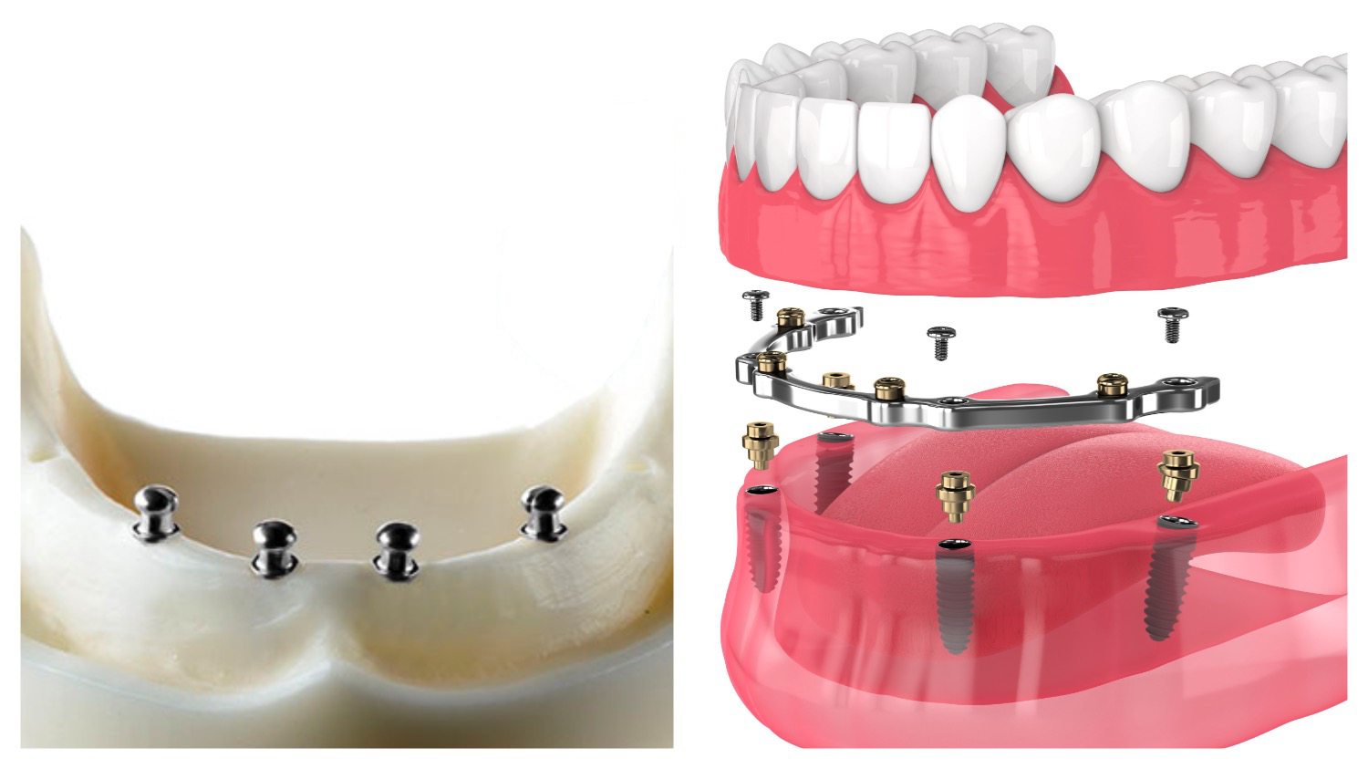 Dental implant supported-denture ball attachments are on the left, and the bar attachment is on the right.