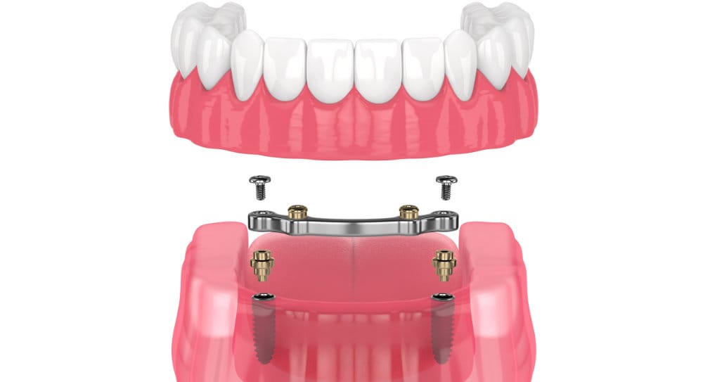 Implant-Supported Dentures