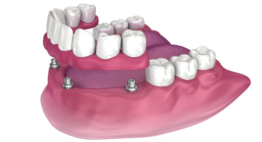 Overdenture to be seated on 4 implants - ball attachments.